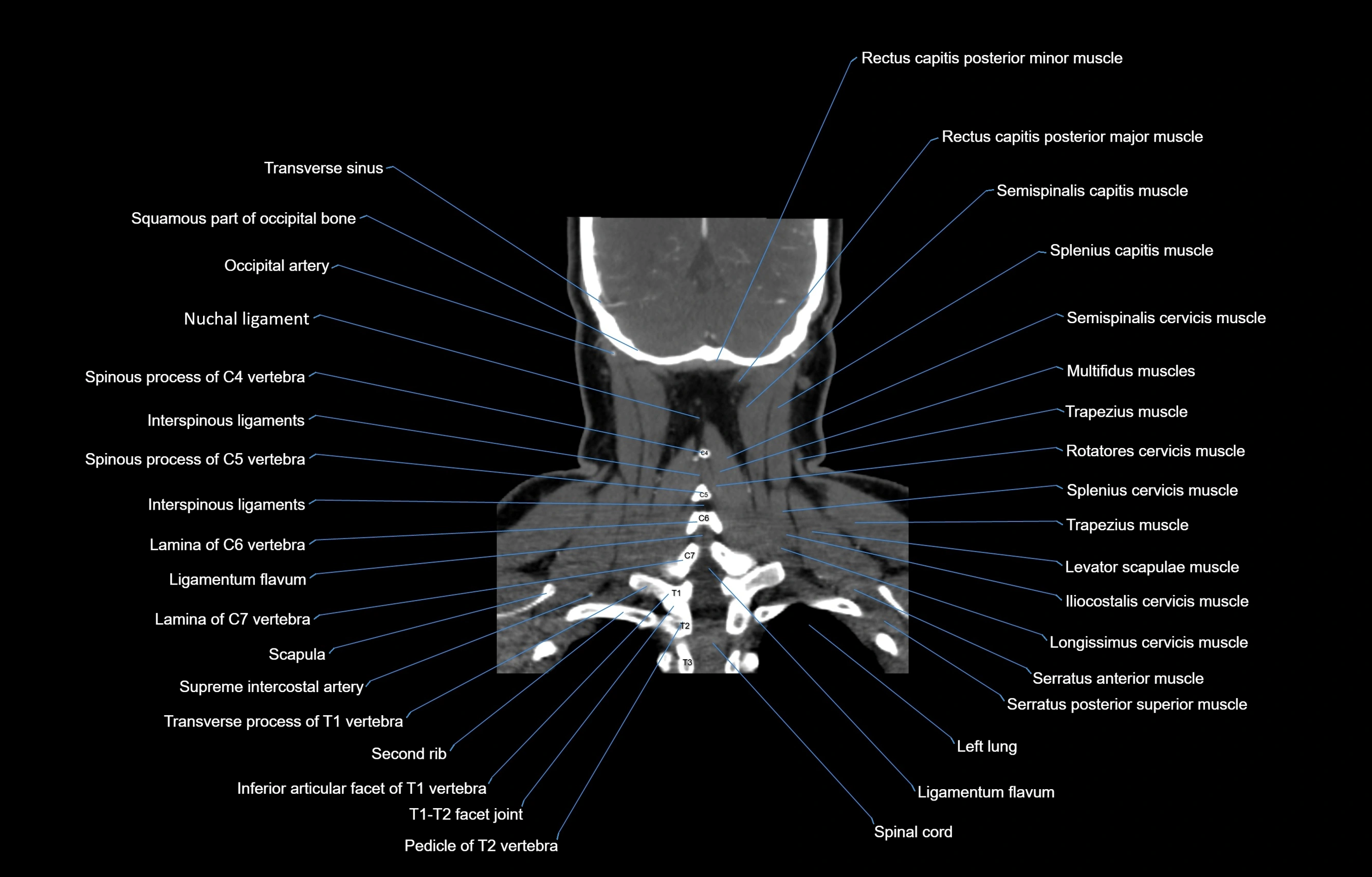 CT Neck coronal  cross sectional anatomy labelled 3D  radiology  image-00053.webp
